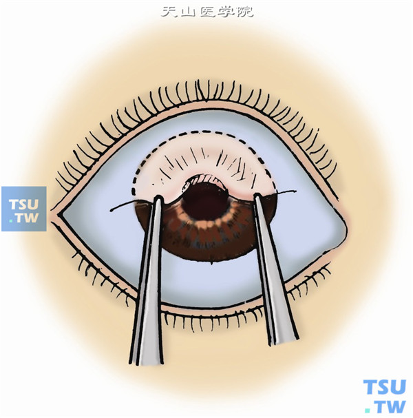 用两把平镊拉起分离后的结膜瓣两端向角膜方向牵引，使其恰好能遮盖角膜病灶