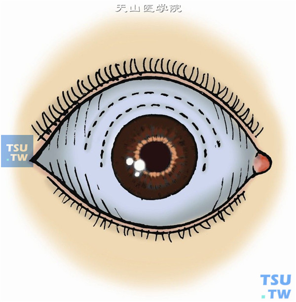 结膜遮盖术图片