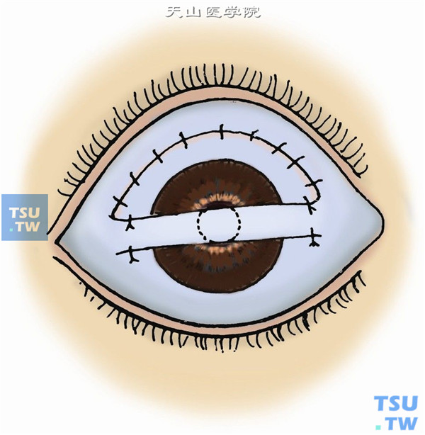 .用9-0尼龙线将桥形结膜瓣两侧蒂部上、下侧各缝一针固定于浅层巩膜上，结膜瓣即遮盖角膜病变区。上方缺损球结膜不必处理，或作间断缝合。如结膜瓣松动，必须在角膜病变的两侧方，用10-0尼龙线各缝合一针