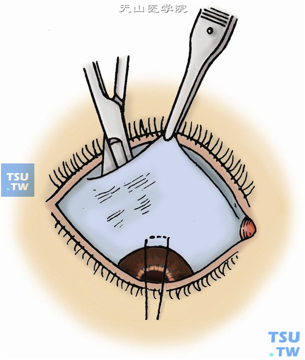 自切口向下分离球结膜至角膜缘使其形成一巨大结膜瓣，注意不能分穿结膜及伤及筋膜囊组织