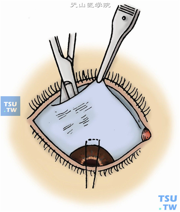 结膜遮盖术图片