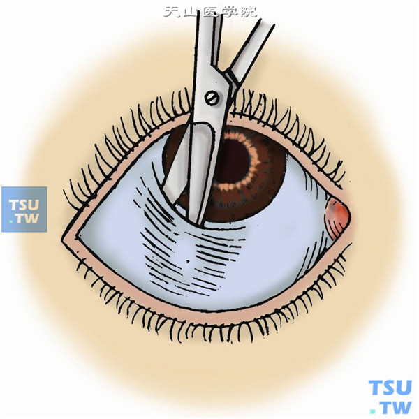沿角膜缘全周剪开球结膜，并分离鼻下方和颞下方结膜，使其稍后退