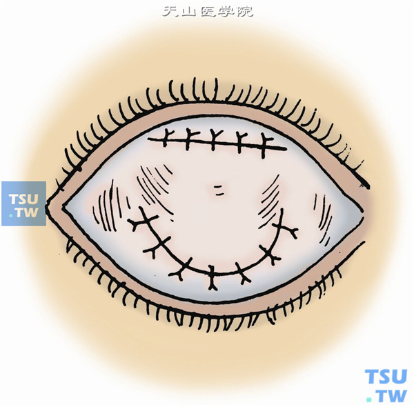 结膜上缘与上穹窿结膜剪口缘不必缝合，可自然愈合，也可间断缝合