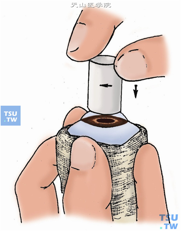将供眼用纱布条带裹紧，一手持眼球，稍施加压力，以恢复供眼的眼压
