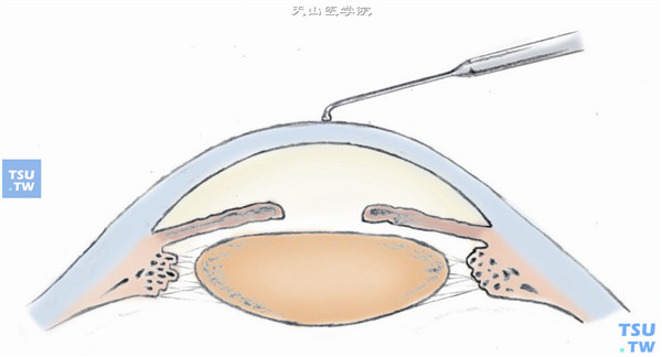 手术显微镜下，用手术标记笔或钝针头在角膜前表面制作中央标记