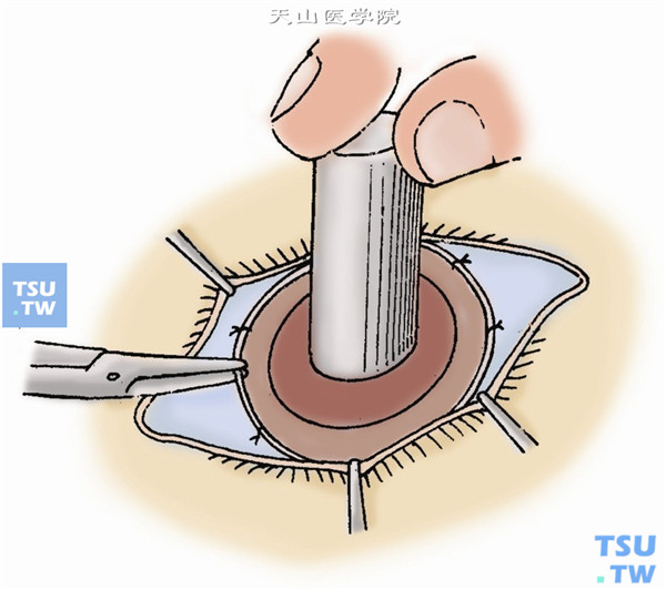手持环钻以角膜定位中心为圆心旋转制作植床，钻切深度为角膜厚度的3/4