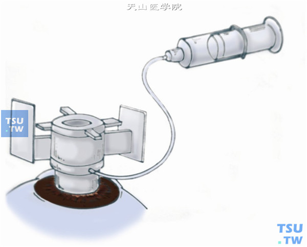 或采用Hessburg-Barron真空环钻，该环钻有双环及附有抽真空的导管及注射器，环钻中央有“十”字标志，使环钻准确对正已标记的角膜的光学中心，使该环钻吸附于角膜上，将内环的手柄旋转一周，环钻进入角膜深度为0.25mm