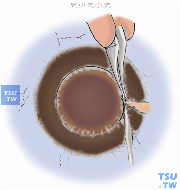 用刀片沿环钻口加深全周切口并切穿进入前房，进入前房最常用的位置是9点时钟位或3点时钟位，房水流出，说明已穿透角膜进入前房