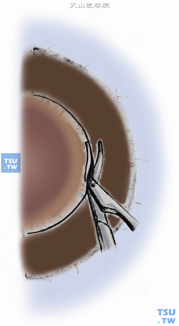 然后用剪刀完成移植床，前房内可注入少量粘弹剂，以便在使用角膜剪完成切除时保护虹膜和晶状体