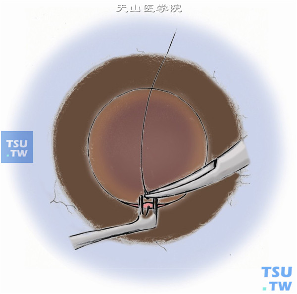 将植片与植床对合，用10-0带铲形针的单丝尼龙线缝合。针垂直于角膜面，当针尖达角膜的3/4厚度或后弹力层时，再平行于角膜面出针