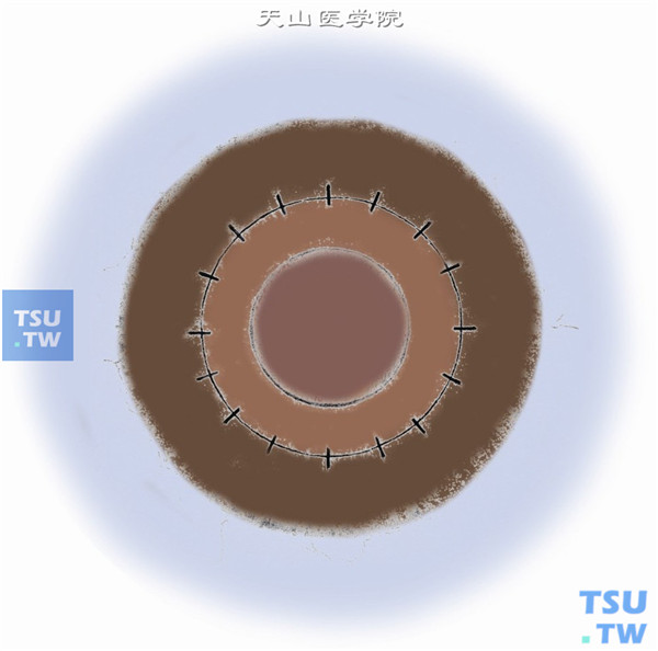 对称缝合16～20针，线结埋藏在移植床侧的角膜组织内