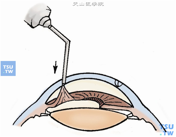 如发现虹膜前粘连，可由手术切口伸入，用平针头注水或粘弹剂，推压分离开前粘连的虹膜
