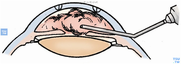 或在角膜缘另开切口，往前房注入粘弹剂
