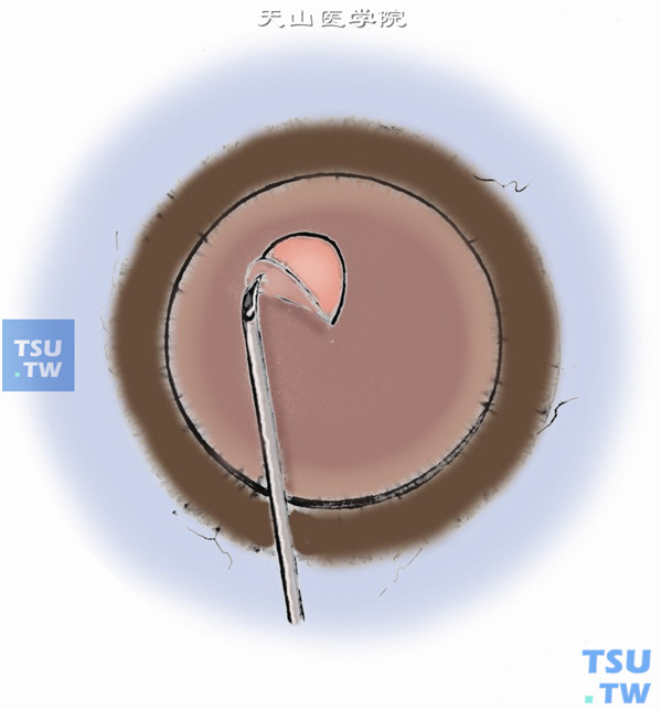 完成角膜移植床的制作后，通过植孔进行环形撕囊，撕去瞳孔区6mm左右直径的前囊膜或用囊膜剪剪除前囊膜