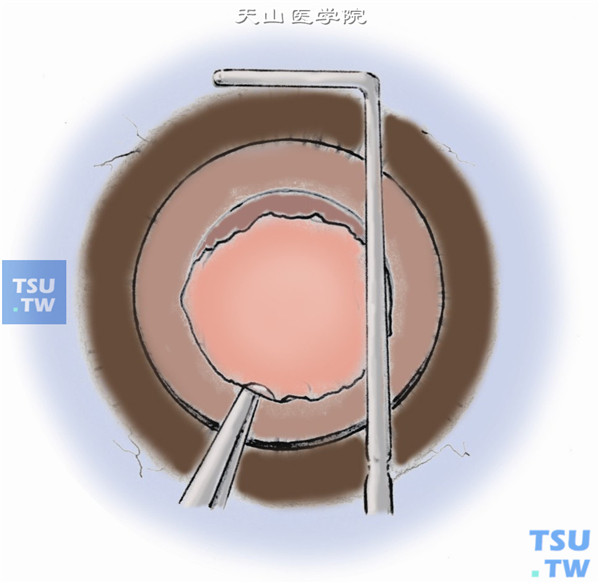 穿透性角膜移植联合手术操作及注意事项