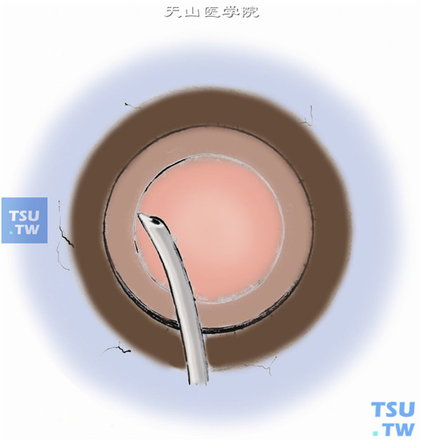 晶状体皮质用自动或人工灌注抽吸系统，通过穿透角膜移植床孔清除皮质