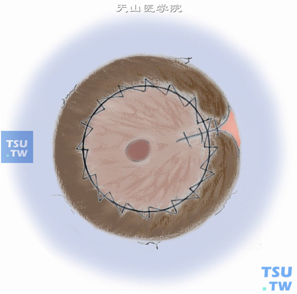 制作角膜移植植床后，无齿镊抓住虹膜瞳孔缘，用10-0聚丙烯缝线，在近瞳孔缘虹膜括约肌处穿过做间断缝合，然后再于虹膜中腹全层间断缝合1～2针，周边部不需缝合