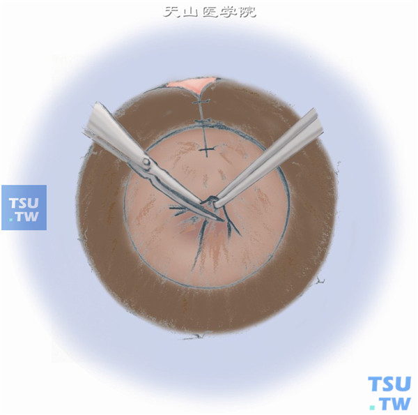 如虹膜面有机化粘连可分离剪除，然后将两侧虹膜对齐间断缝合，并将6点方位瞳孔缘向下剪开少许，修整形成中央瞳孔