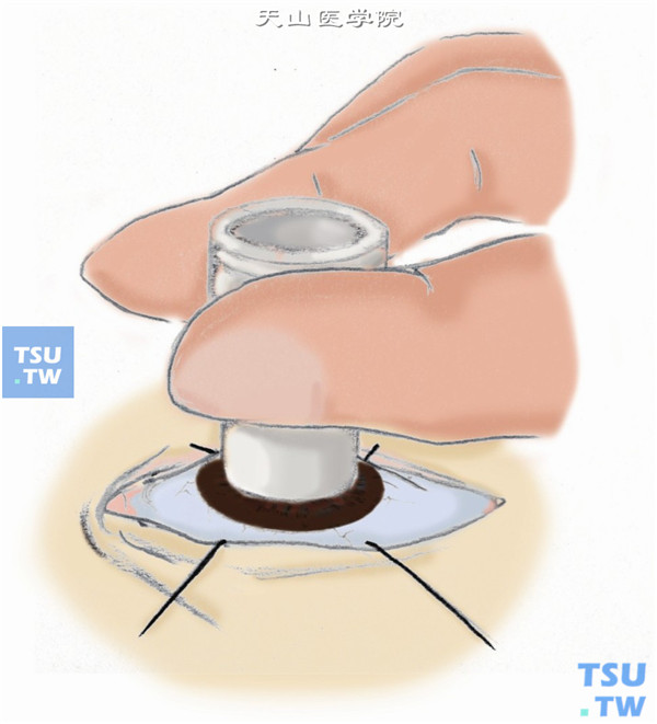 植片的制作方法同前，制作受眼角膜植床，环钻约比植片小0.2mm左右，钻切角膜2/3深度以上，勿直接钻穿前房