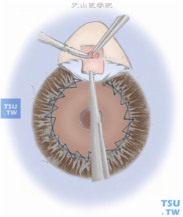 图10：在巩膜瓣下切除含有小梁组织的角巩缘组织大小为2mm×1.5mm，并做周边虹膜切除。回复巩膜瓣，用10-0尼龙线两角各缝一针，及垂直于两边的切口各缝一针