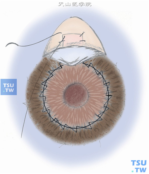 图11：在巩膜瓣下切除含有小梁组织的角巩缘组织大小为2mm×1.5mm，并做周边虹膜切除。回复巩膜瓣，用10-0尼龙线两角各缝一针，及垂直于两边的切口各缝一针