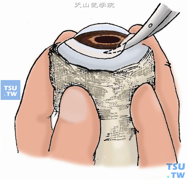 再水平切开眼球，用剪刀水平剪出带板层巩膜环的全厚角膜片