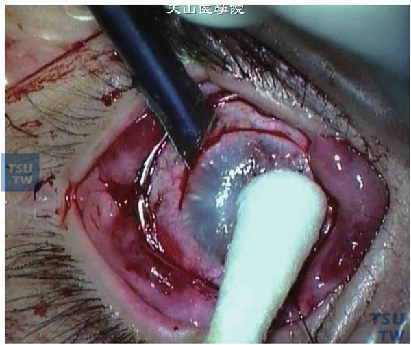 沿角膜缘切开剪除病变的全角膜