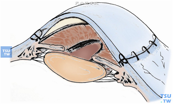 眼前段重建术操作及注意事项