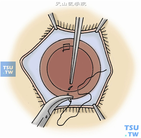 将球结膜复位缝合，使其遮盖巩膜瓣