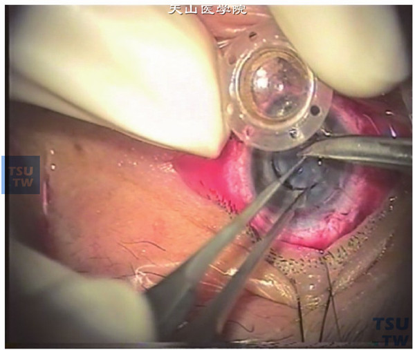 以比拟植入临时人工角膜直径小0.25mm的环钻在伤眼的角膜中央作角膜移植孔，将临时人工角膜旋入植床