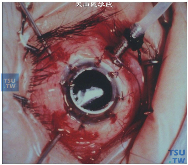 眼角膜图片摘除手术图片