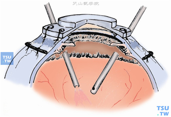 应用临时人工角膜行穿透性角膜移植联合玻璃体及视网膜手术