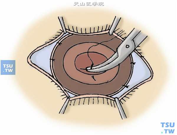 完成眼内后段各种必要的手术后，缝合上方两个巩膜穿刺口，然后取出临时人工角膜，按常规完成部分穿透性角膜移植术
