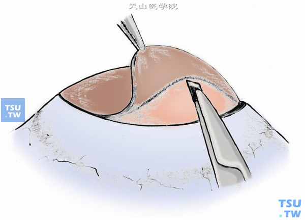 高倍放大的手术显微镜下，显微镊提起环钻切口边缘，用尖剃须刀片从切口底部开始剖切，先剖出环钻划界的一部分角膜前层，观察植床底是否透明，然后按同一板层平面进行剖切，直至全部浑浊角膜组织以及新生血管清除干净