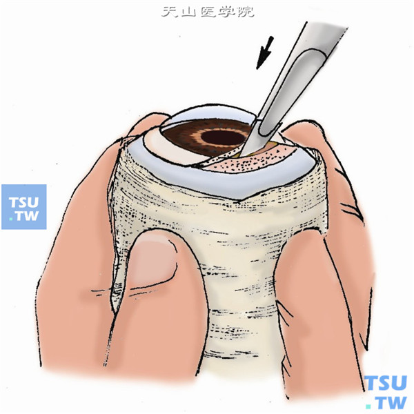 在眼球制取移植片：先用纱布紧绕眼球以提高眼压并保持规则的角膜弯曲面，然后在角膜缘做一深度适宜的板层小切口（一般深度约0.5mm）