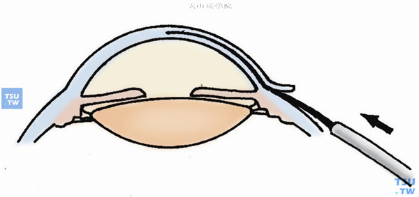 按板层所在的平面左右摆动，并向前推动将角膜逐渐分成两层