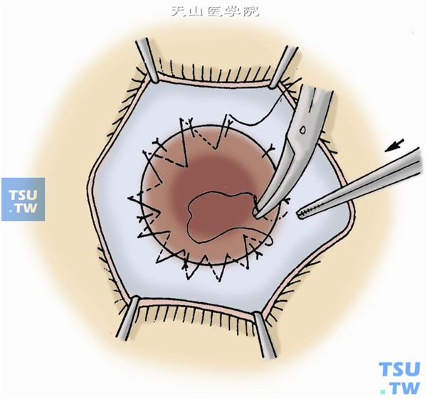 将移植片放在移植床上，用10-0尼龙线间断或连续缝合固定于移植床