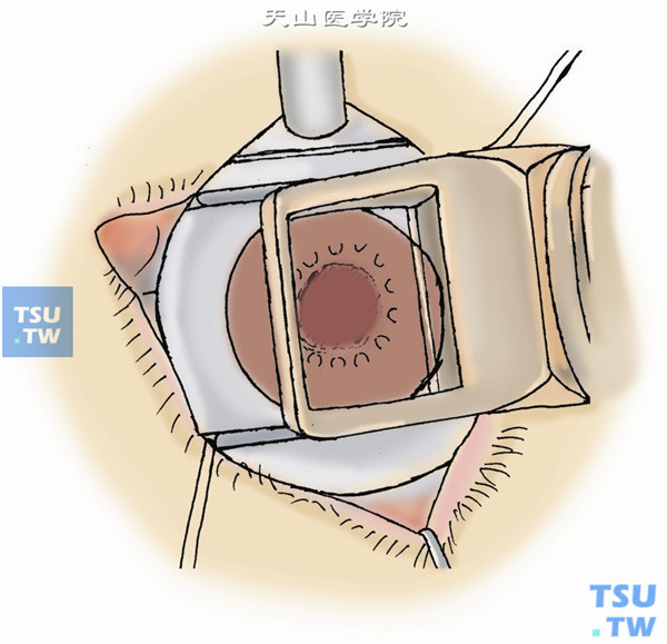 用微型角膜刀对患者角膜施行横向板层切开，获得一以鼻侧为基底的带蒂角膜瓣
