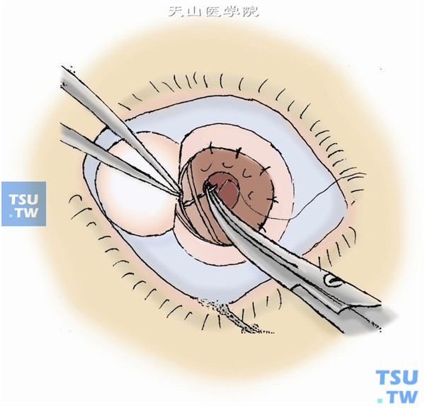 供体角膜基质片内皮向下植入植床。用缝线缝合至水密状态，将植片固定于植床