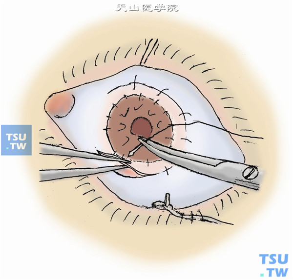 将带蒂的前角膜组织瓣复位并严密对合，用10-0缝线间断缝合原位固定