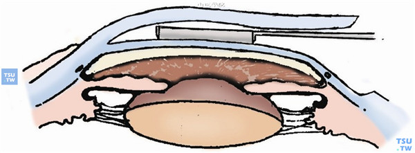 形成360°的角膜基质袋：将特殊的基质内环钻（Terry环钻）置于基质袋中，前房内注入Healon粘弹剂，转动Terry环钻在后基质角膜上可见清晰的环钻切迹并切通前房。用特制的弧形角膜剪（左、右剪）沿环钻切迹环形剪除病变角膜组织并将其取出
