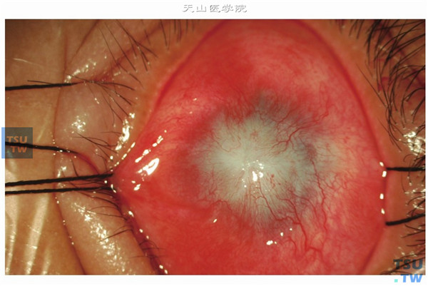 角膜前基质层以及角膜内皮层均发生病变的高危角膜移植病例