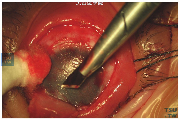 植床的制备：在暴露的巩膜床上烧灼止血后，用剃须刀片在角膜缘后1mm进行划界，深度约2/3角膜厚度，剖切去除角膜前板层