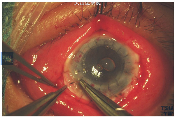 将带有角膜缘的前板层植片间断缝合固定于板层植床