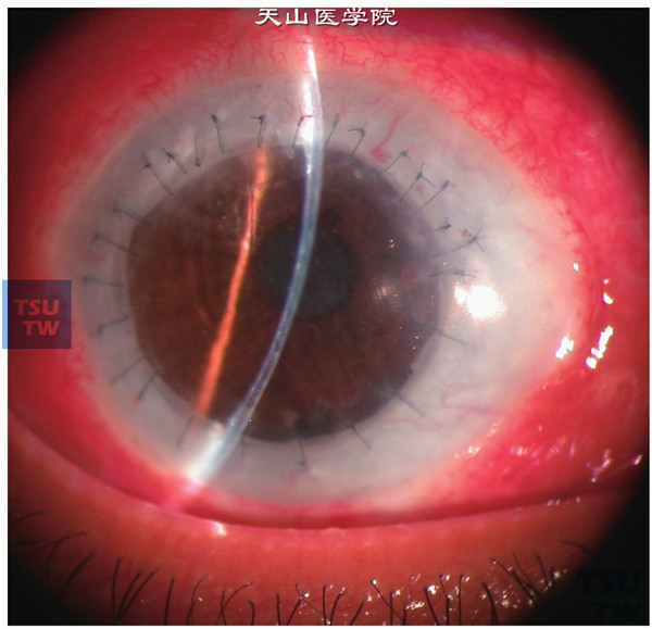 角膜结膜瓣遮盖术案例图片