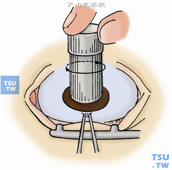 缝线开睑，上下直肌牵引固定缝线固定眼球。用环钻做约0.3mm深的板层移植床划界，环钻的口径以能完全去除病灶为度