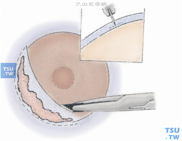 可用环钻或较宽的刀片自由划界，划界的范围以彻底切除病变的角膜组织和符合手术设计，角膜内的划界一般应在距离病灶外0.5～1mm左右的健康角膜处