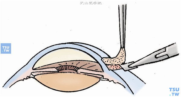 用单齿镊夹起病灶尖端的板层角膜组织，进行板层剖切，深度以能去除溃疡浸润组织为度