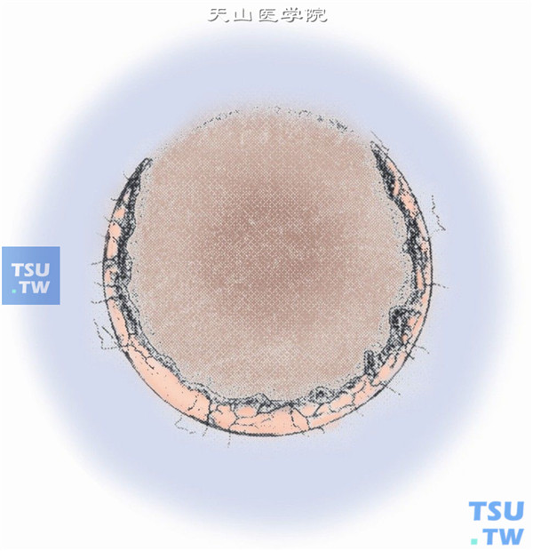 病变大于2/3圆周，但瞳孔区尚有7～8mm健康者，采用指环形板层移植片