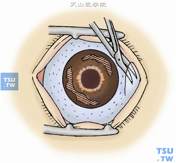 沿角膜缘剪开全周球结膜，向后分离暴露约5mm巩膜，烧灼止血